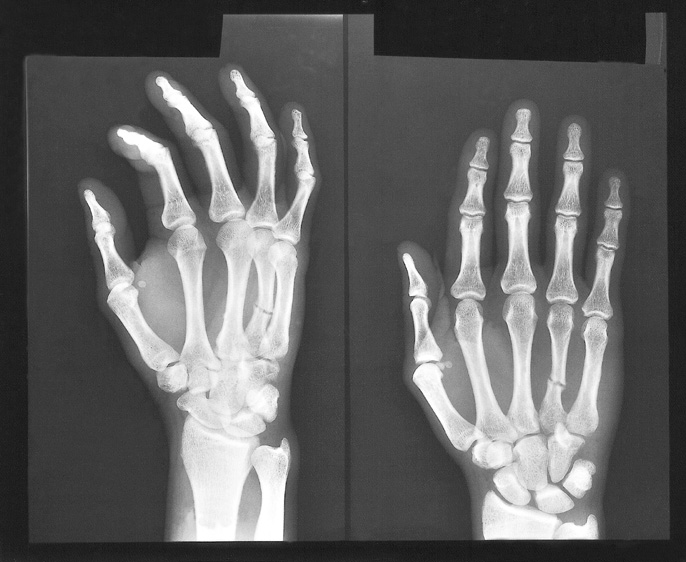 x ray of fractured hand